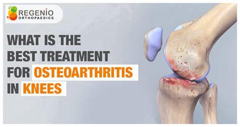 Best Treatment For Osteoarthritis In The Knees Regenio