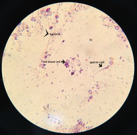 Urine Under Microscope Presence Of Red Blood Cells Bacteria And Sperm