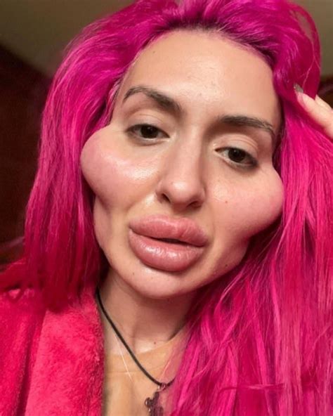 Instagram Model With World S Biggest Cheeks Wants More Surgery Face