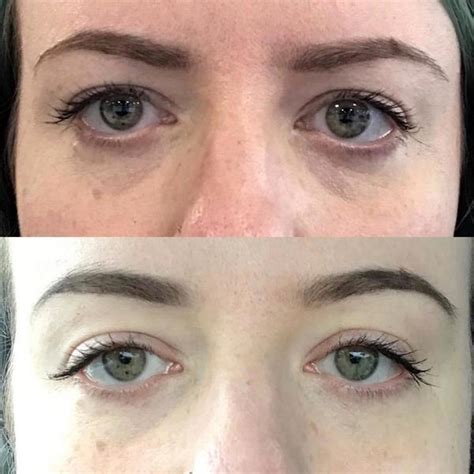 From the before and after pictures to side effects, here's 9 things i learnt from having botox in my 20s. The Botox Brow Lift Explained » Facial Injections: Info ...
