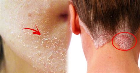 Dehydration is the excessive loss of body water. Trending Now Experiencing Dry Skin And Hair Loss? This ...