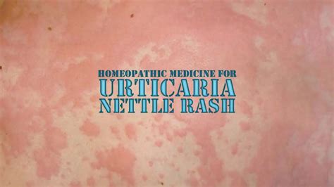 Homeopathic Medicine For Urticarianettle Rash Homeopathic Medicine 4