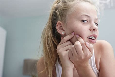 10 Tips For Treating Teen Acne For Girls