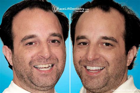We did not find results for: Straight Teeth without Braces