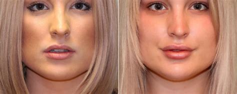 lip augmentation before and after photos page 6 of 6 the naderi center for plastic surgery
