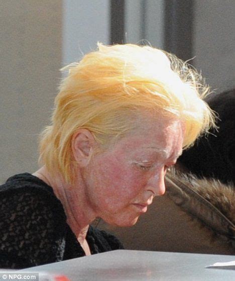 That Looks Painful Cyndi Lauper Shows Off Red Sore Looking Skin As