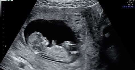 It's MY LIFE: Pregnancy Update #5 - Second Ultrasound