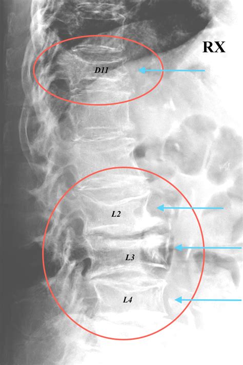 Terapia del Dolore Interventistica Vertebrale ...