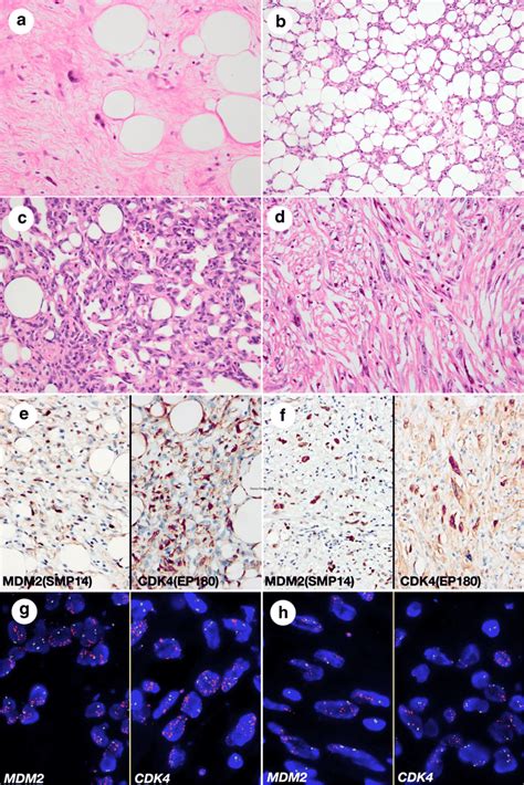 The Histologic Features Of Atypical Lipomatous Tumor Download