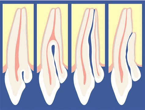 dens invaginatus | Dental Press | O Portal de conteúdo de Odontologia