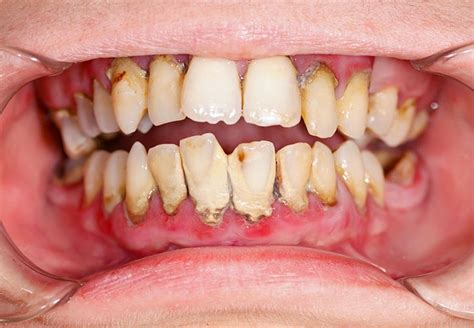 Tooth Decay And Plaque Pearson Dental