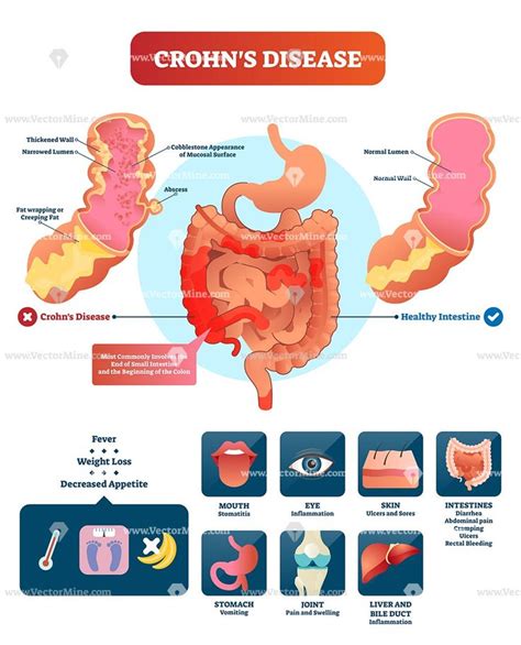 Drug therapy for ulcerative colitis and crohn's disease during pregnancy is a very actual problem, because the peak of their development falls on the period of childbearing. Crohns disease anatomical vector illustration infographic ...
