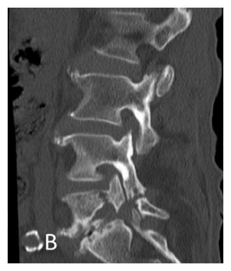 Sagittal Reconstruction Ct Confirming Bilateral Spondylolysis And