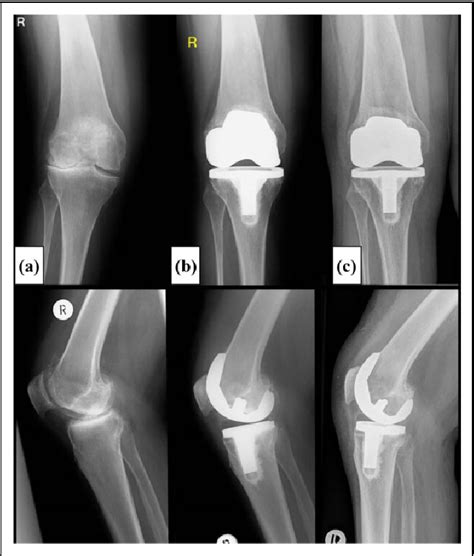 Figure 3 From Cementless Femoral Components In Bicondylar Hybrid Knee