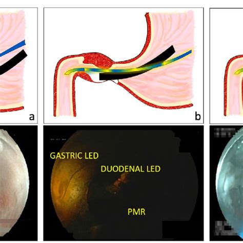 Animation And Endoscopic Image Of G Poem Procedure Guided And Confirmed