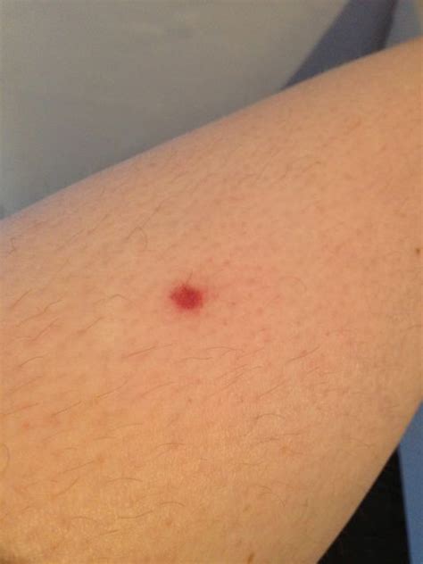 I Have A Patch Of Red Dots On My Leg Glosoftware