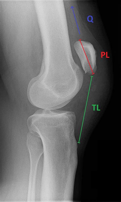 A Man With Knee Pain After A Fall The Bmj