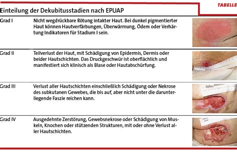 Die behandlung von intertrigo sollte sehr sorgfältig durchgeführt werden. Prophylaxe Archive - Pflegeprof...