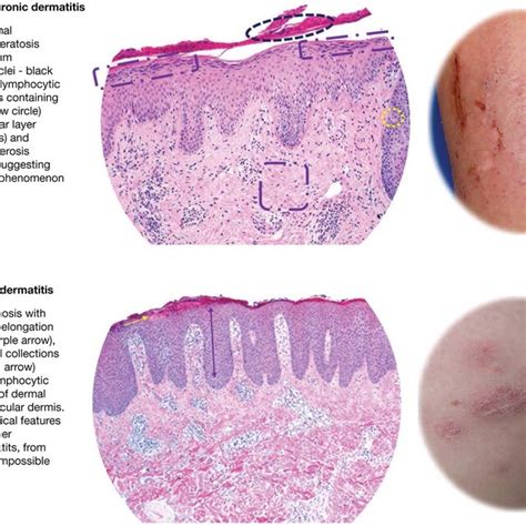 Atopic Dermatitis Histology A Normal Skin B Atopic Dermatitis