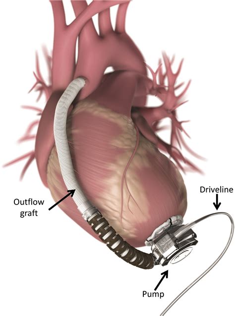 The Intra Aortic Balloon Pump And Other Methods Of Mechanical