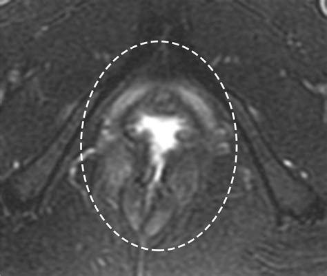 Imaging And Surgical Management Of Anorectal Vaginal Fistulas Radiographics