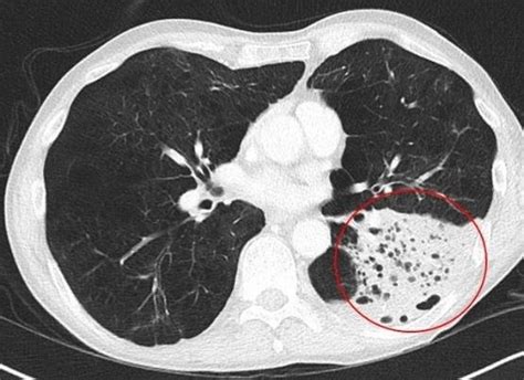 Thoracic Ct With Contrast Showing Lobar Consolidation With Increased
