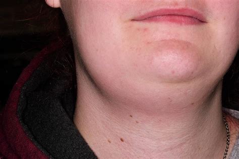 Where Are Lymph Nodes In Neck Milopc