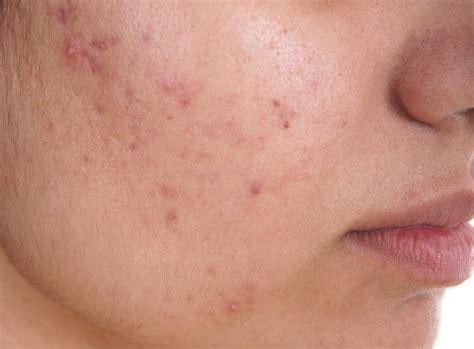 Acne Causes Treatment And Tips