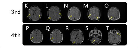 Brain Mri Findings From The Third And Fourth Scans Third Mri Scan