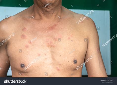 60yearold Man Has Blistering Rash There Stock Photo 1998737447