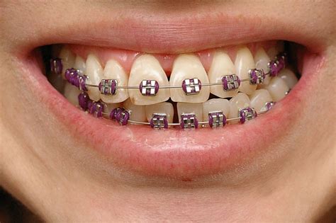 Favorite Color Like Purple Teeth Braces Braces Teeth Colors Braces Colors