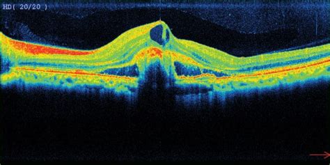 Macular Degeneration Grace And Vision Optometrist Brisbane
