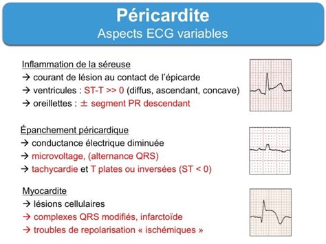 46,334 likes · 145 talking about this. Péricardite aiguë. 1 typique : e-cardiogram