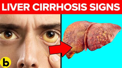 Warning Signs Symptoms And Causes Of Cirrhosis Of The Liver Youtube