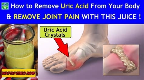 How To Remove Uric Acid From Your Body And Reduce Joint Pain With This