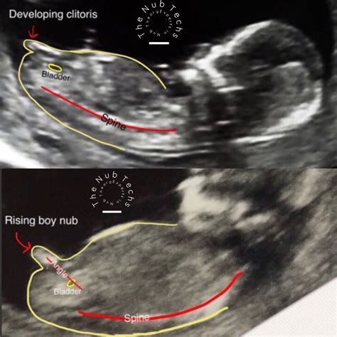 Male gender may already be reliably determined when crl ≥ 55 mm (gestational age ≥ 12+0). Heard about the nub theory? This is not a fun old wives ...