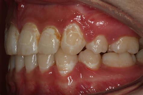 New Glue For Braces May Mean No More White Blotches