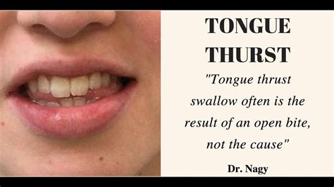 Tongue Thrust Treatment For Adults Jacobos Mezquita