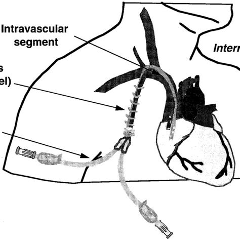 Internal Jugular Central Venous Catheter