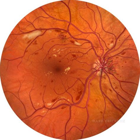 Proliferative Diabetic Retinopathy Fundus Illustration Featuring Nvd