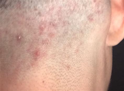 Anybody Know Why I Get These Red Bumps On My Head After Every Cut R