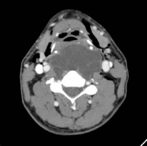 Computed Tomography Of The Neck With Intravenous Contrast Axial Cut