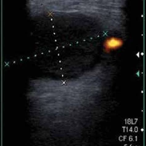 Neck Ultrasonography Abscess Formation In The Smooth Contour With