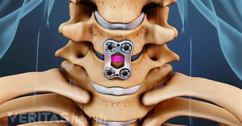 Outpatient Anterior Cervical Discectomy And Fusion Acdf