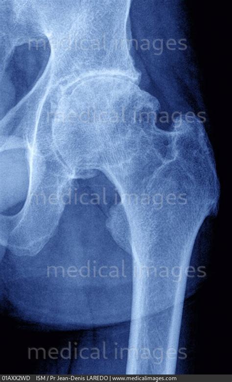 Stock Image Ankylosing Spondylitis Coxitis With Bone Erosion Of The