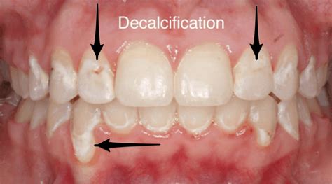 What Is Decalcification Of Teeth Archwired