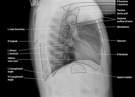 Lateral View Of Chest X Ray