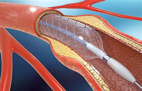 How Do Stents Work Bhf