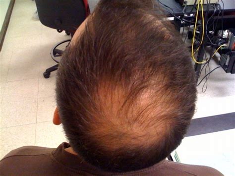 En Qu Consiste La Alopecia Androg Nica Capilclinic