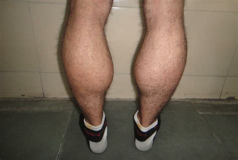 Swollen Calf Muscle One Leg